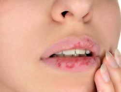 Masalah Mulut dan Gigi Yang Muncul Akibat Stress